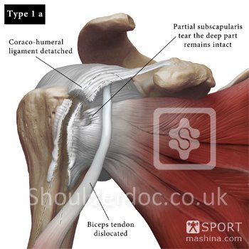 biceps dislocation type 1 a web.jpg